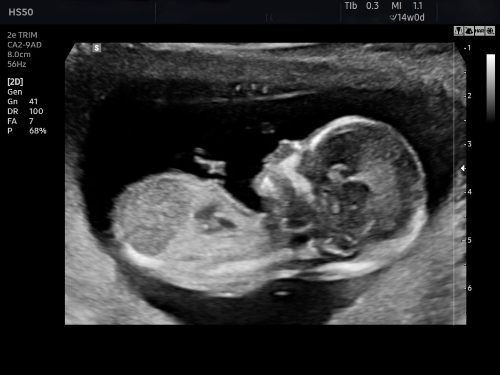 13 weken echo - Echopraktijk Wereldkiek